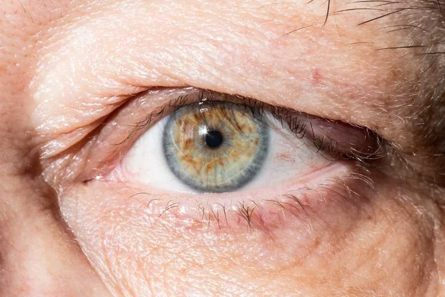 düşük-göz-kapağı